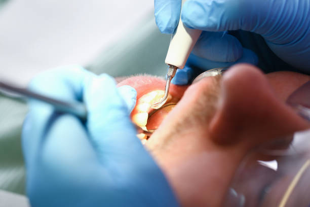 Best Emergency Tooth Extraction in Good Hope, AL