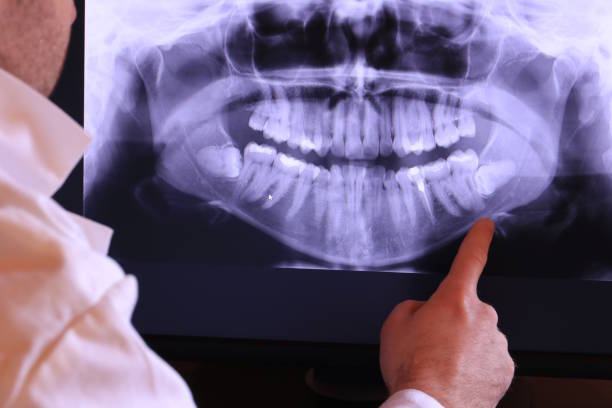 Best Emergency Wisdom Teeth Removal in Good Hope, AL